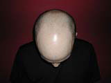 Brain Surgery