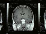 Brain Surgery
