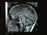 Brain Surgery