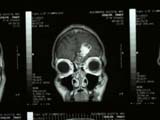 Brain Surgery