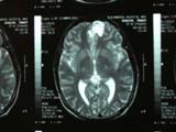 Brain Surgery