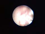 Brain Surgery