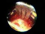 Brain Surgery