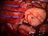 Brain Surgery