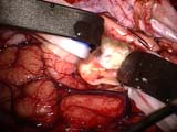 Brain Surgery