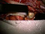 Brain Surgery