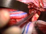 Brain Surgery