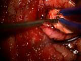 Brain Surgery