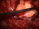 Brain Surgery