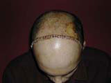 Brain Surgery
