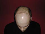Brain Surgery