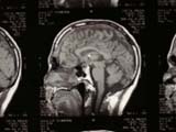 Brain Surgery