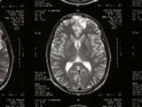 Brain Surgery