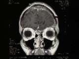 Brain Surgery