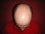 Brain Surgery
