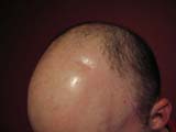 Brain Surgery