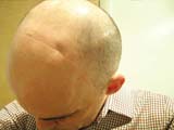 Brain Surgery