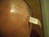 Brain Surgery