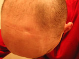 Brain Surgery