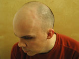 Brain Surgery