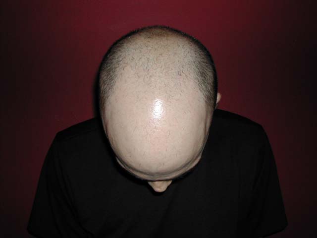 Brain Surgery