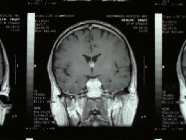 Brain Surgery