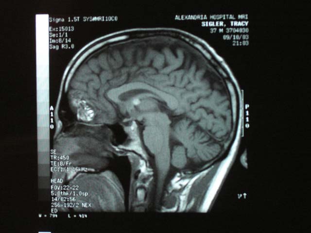 Brain Surgery