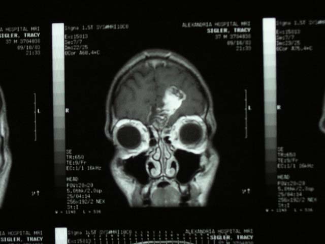 Brain Surgery