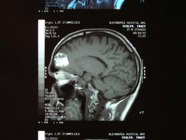 Brain Surgery