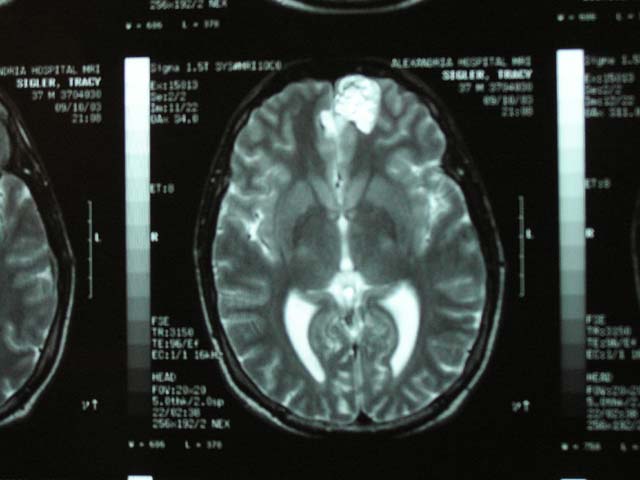 Brain Surgery