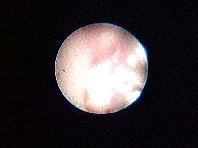 Brain Surgery