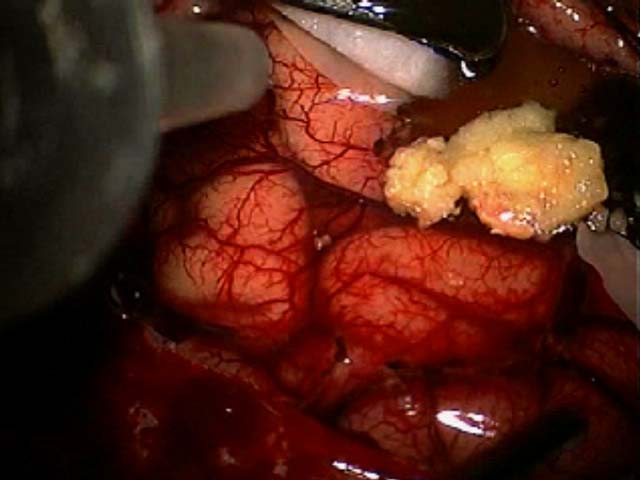 Brain Surgery