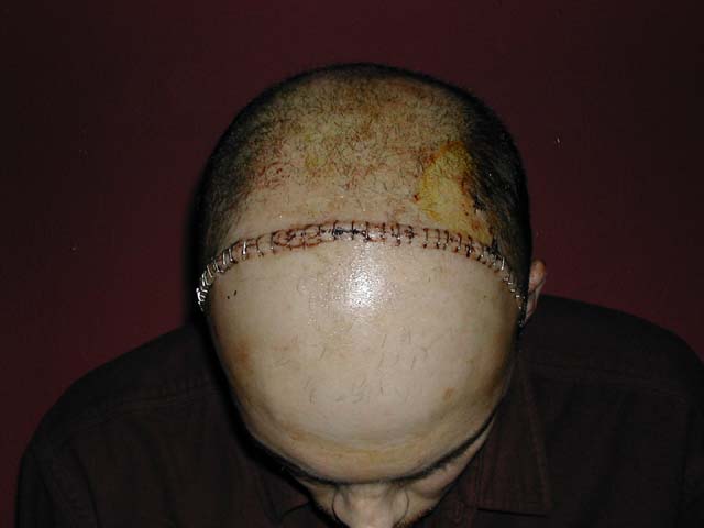 Brain Surgery