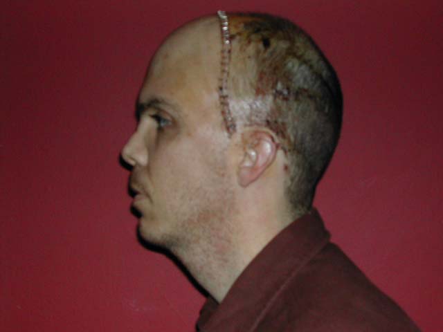 Brain Surgery