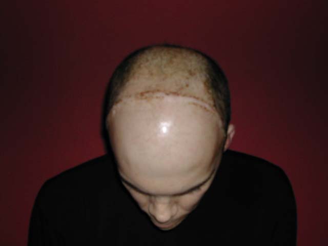 Brain Surgery