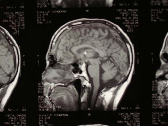 Brain Surgery