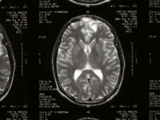 Brain Surgery