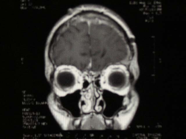 Brain Surgery