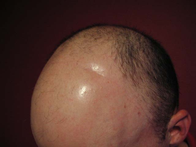 Brain Surgery