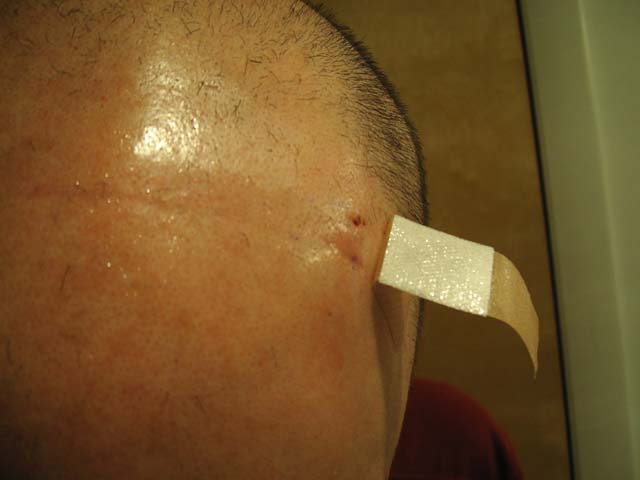 Brain Surgery