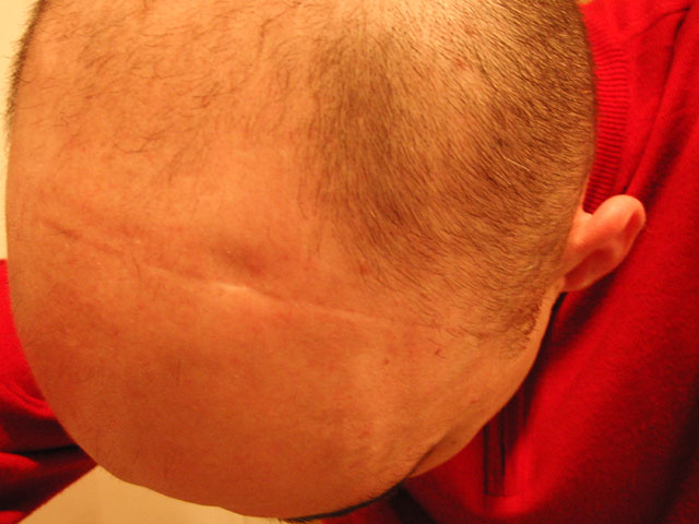 Brain Surgery